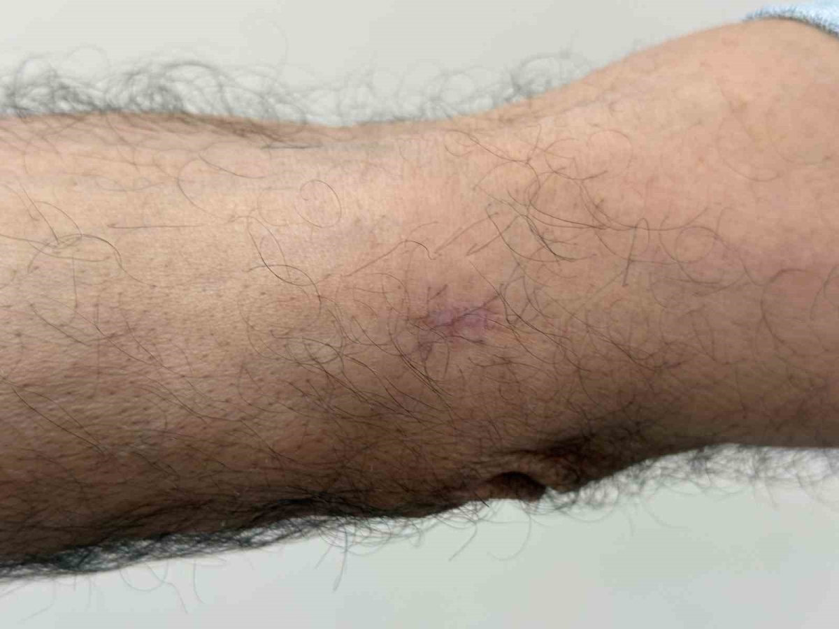 Kolundaki yara için gitti, kanser olduğunu öğrendi

