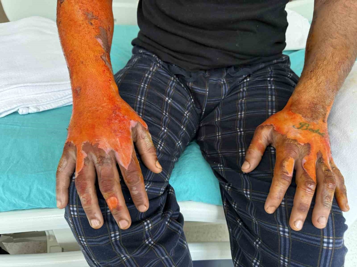 Akü patlaması, vücudunun yüzde 25’i yandı: 